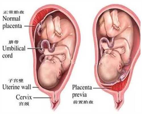 西安代生双胞胎免费咨询_孕晚期能不能吃方便面